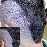 Камуфляж рубцов