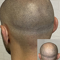 Маскировка шрамов/рубцов